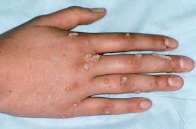 Bệnh hạt cơm ngoài da thường gặp