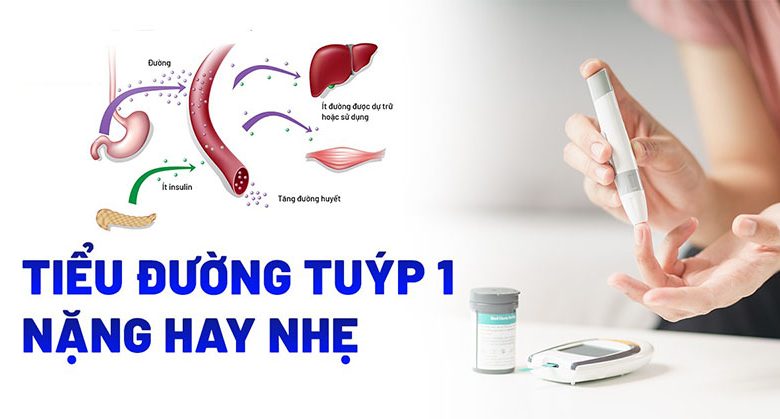 Tiểu đường tuýp 1 là gì? Tiểu đường tuýp 1 là nặng hay nhẹ